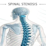 Medical illustration of a spine cross-section showing spinal stenosis, used for a lesson on the Kore...